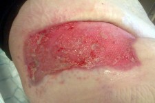 Infezioni necrotizzanti dei tessuti molli (I.N.T.M.)