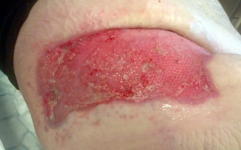 Infezioni necrotizzanti dei tessuti molli (I.N.T.M.)